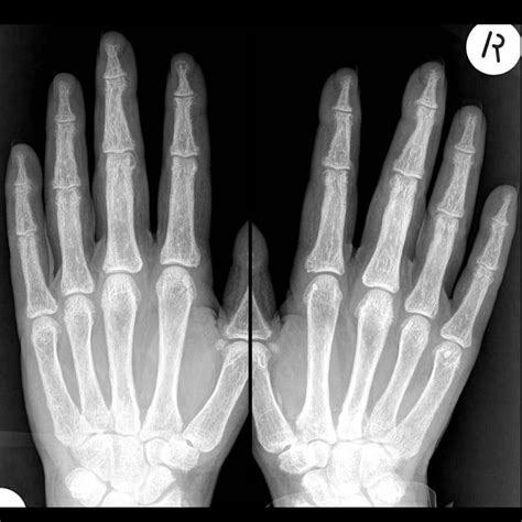 Contact information for aktienfakten.de - The American College of Radiology's Appropriateness Criteria recommend radiography as the optimal technique for evaluating bone tumors . A precise history, physical examination, radiographs, and laboratory examinations are adequate for the diagnosis and appropriate treatment of most osseous tumors of the hand . Radiographs are relatively ...
